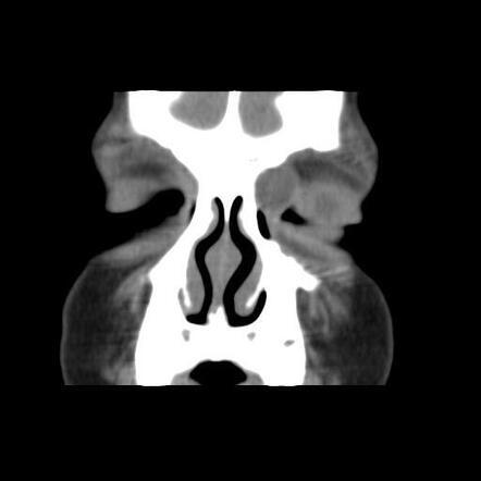 eyelid dermoid cyst icd 10