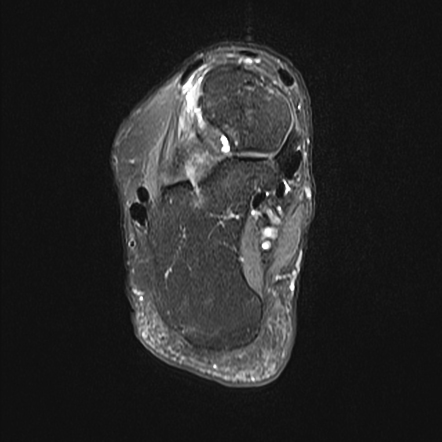 Intra-articular Tenosynovial Giant Cell Tumor - Ankle 