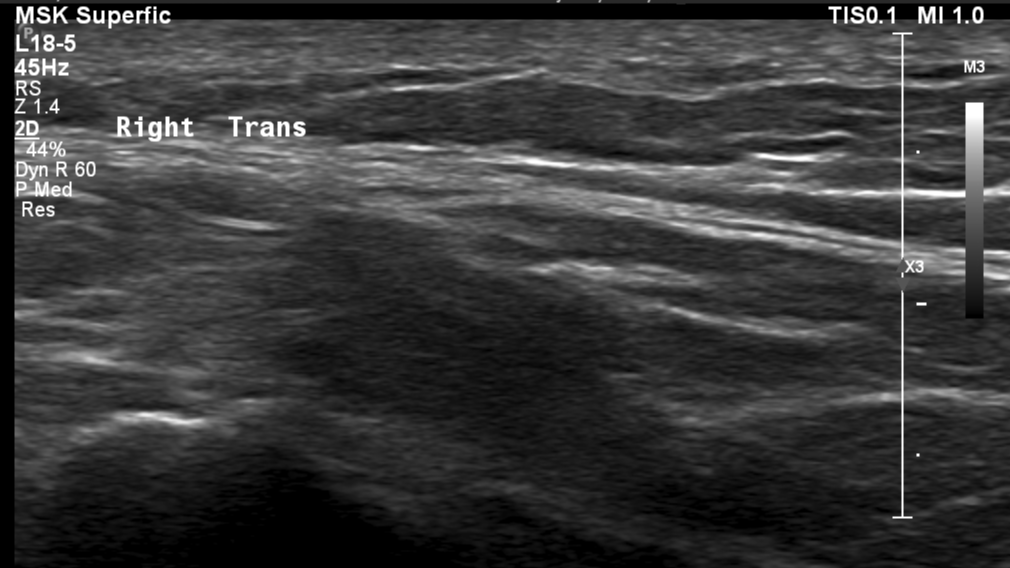 Episacral lipoma - 