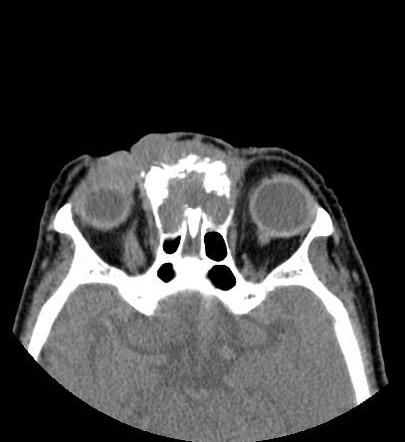 Eyelid basal cell carcinoma | Radiology Case | Radiopaedia.org