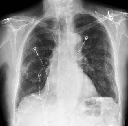 Asbestos exposure with calcified pleural plaques | Image | Radiopaedia.org