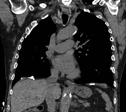 Asbestos exposure with calcified pleural plaques | Image | Radiopaedia.org