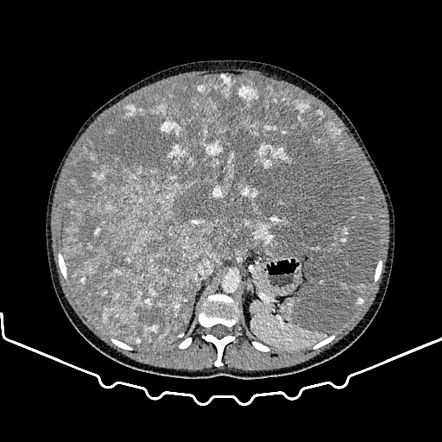 Diffuse hepatic hemangiomatosis | Radiology Case | Radiopaedia.org