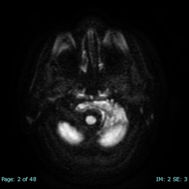 Collet Sicard syndrome | Image | Radiopaedia.org