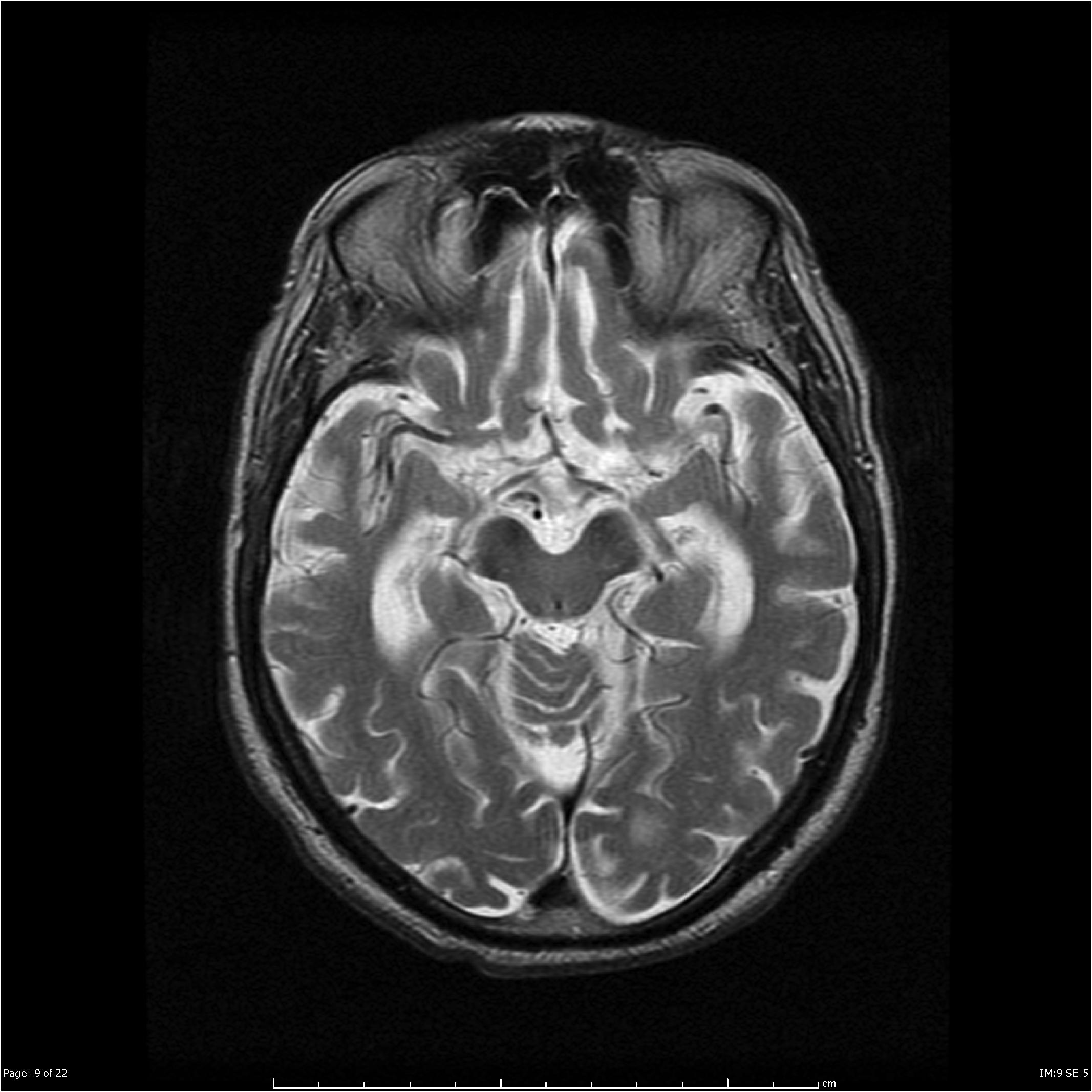 Hummingbird appearance in midbrain atrophy | Image | Radiopaedia.org