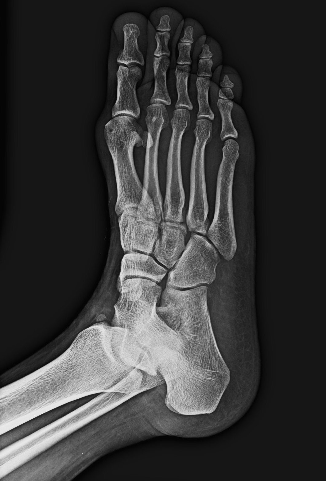 Unfused secondary ossification center of the medial malleolus | Image ...