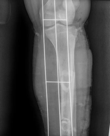 Segmental Fracture Of Tibial Shaft | Radiology Case | Radiopaedia.org