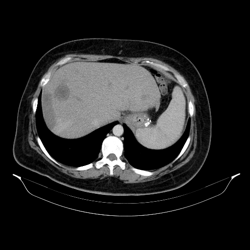 Hepatic epithelioid hemangioendothelioma | Image | Radiopaedia.org