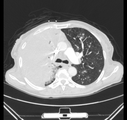 Hypertrophic pulmonary osteoarthropathy | Image | Radiopaedia.org