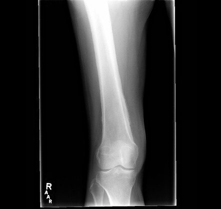 Hypertrophic pulmonary osteoarthropathy | Image | Radiopaedia.org