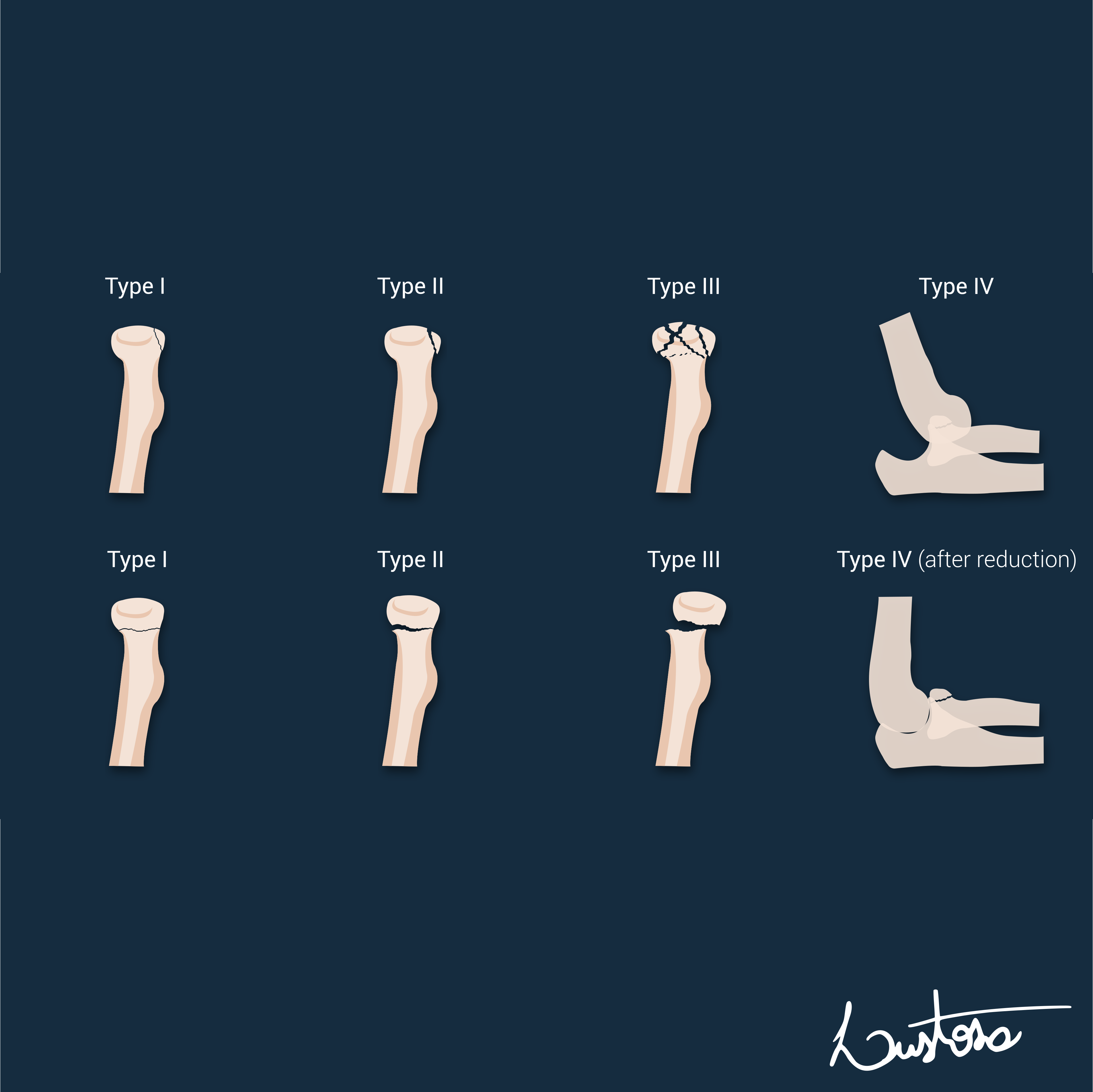 Mason Classification Of Radial Head Fractures Image