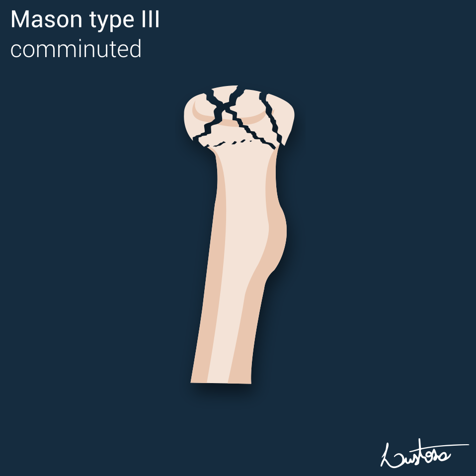 Mason Classification Of Radial Head Fractures Image 8349