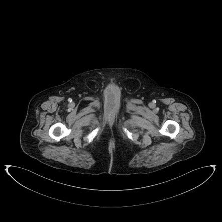 Corpus cavernosum abscess | Image | Radiopaedia.org