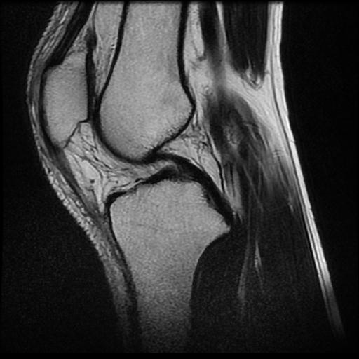 Discoid lateral meniscus | Image | Radiopaedia.org