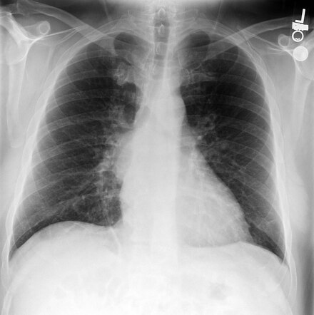 Bronchial duplication cyst | Image | Radiopaedia.org