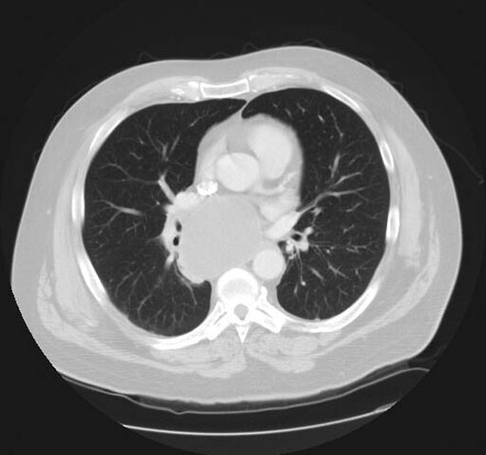 Bronchial duplication cyst | Image | Radiopaedia.org