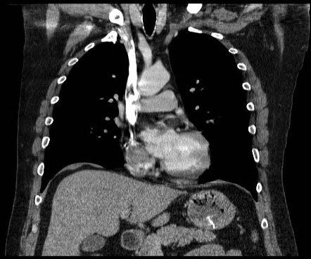 Bronchial duplication cyst | Image | Radiopaedia.org