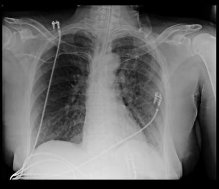 Viewing playlist: Basic chest x-ray pathology | Radiopaedia.org