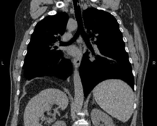 Bochdalek hernia mimics unilateral extrapleural fat | Image ...