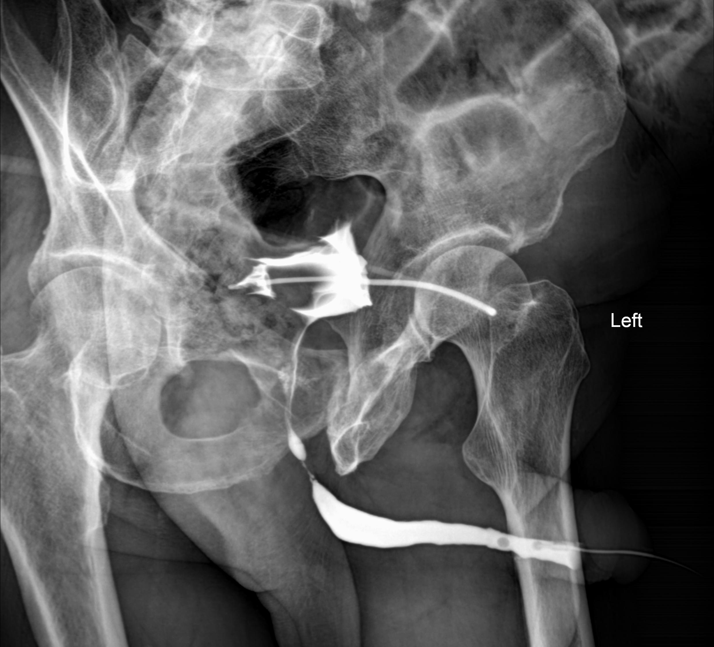 Bulbar Urethral Stricture | Image | Radiopaedia.org