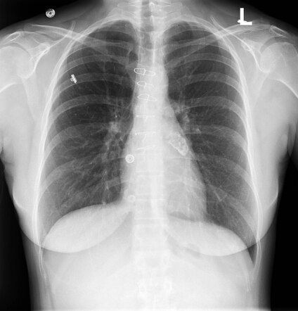 Kawasaki disease | Radiology Reference Article | Radiopaedia.org