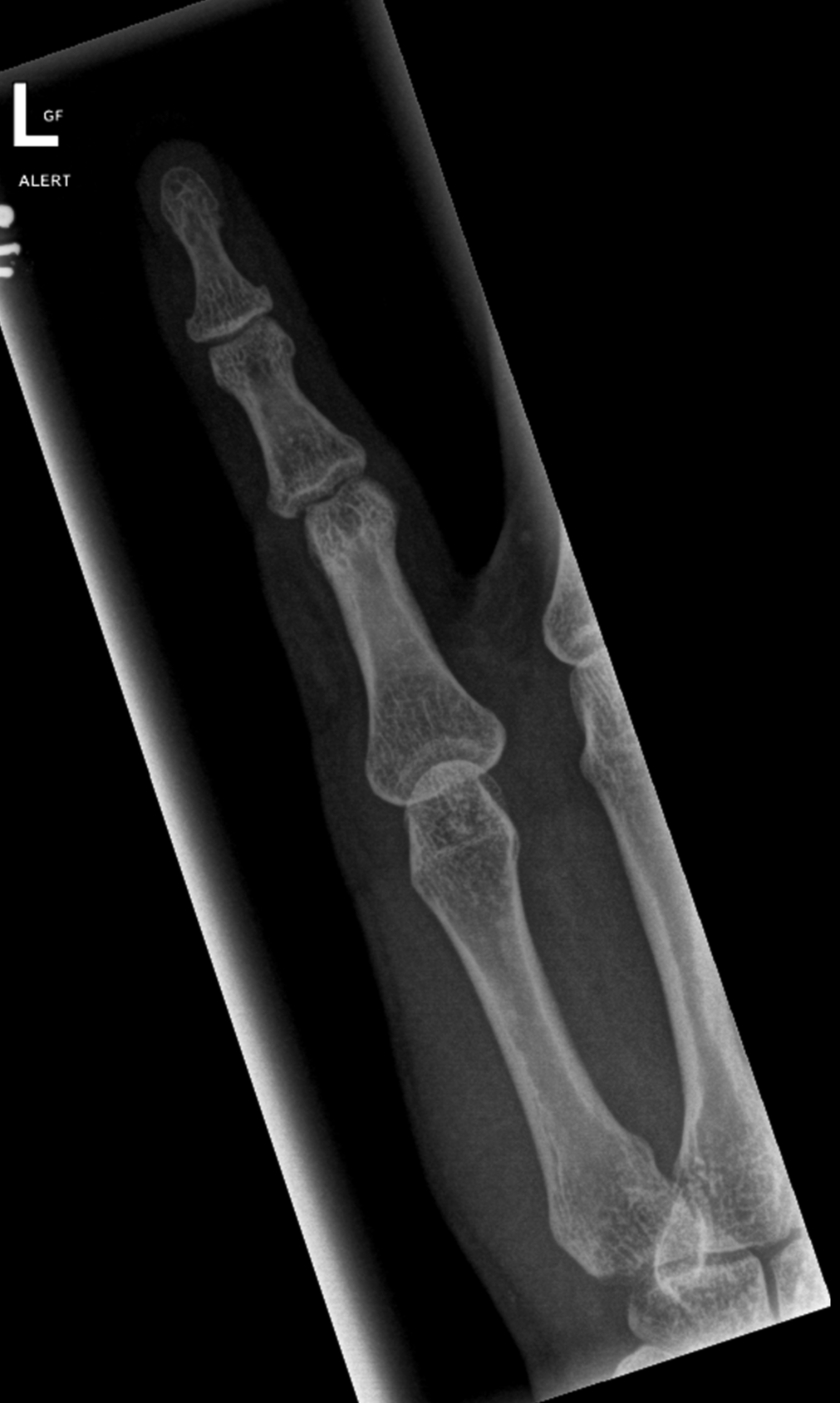 Dislocated proximal and distal interphalangeal joints - hand | Image ...