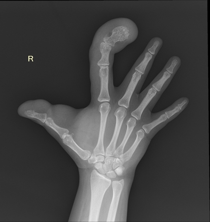 Macrodystrophia lipomatosa | Radiology Case | Radiopaedia.org