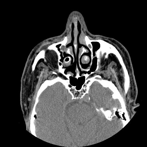 Nasolacrimal duct obstruction | Image | Radiopaedia.org