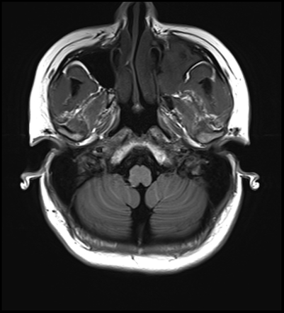 Skull base polyostotic fibrous dysplasia with secondary aneurysmal bone ...