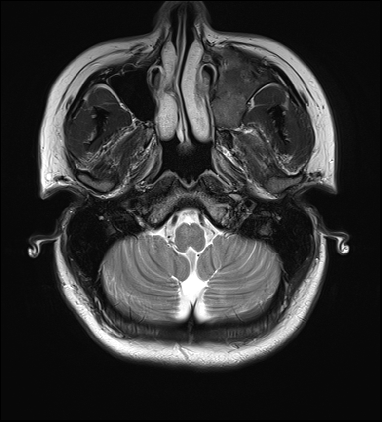 Skull Base Polyostotic Fibrous Dysplasia With Secondary Aneurysmal Bone Cyst Image 0928