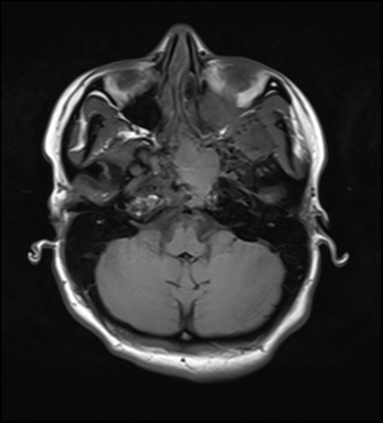 Skull Base Polyostotic Fibrous Dysplasia With Secondary Aneurysmal Bone Cyst Image 9814