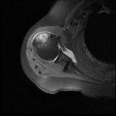 Avulsion Fracture Greater Tuberosity Of Humerus Radiology Case