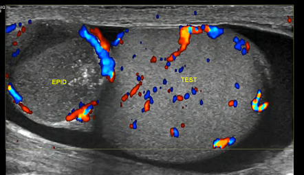 Epididymal abscess | Radiology Reference Article | Radiopaedia.org