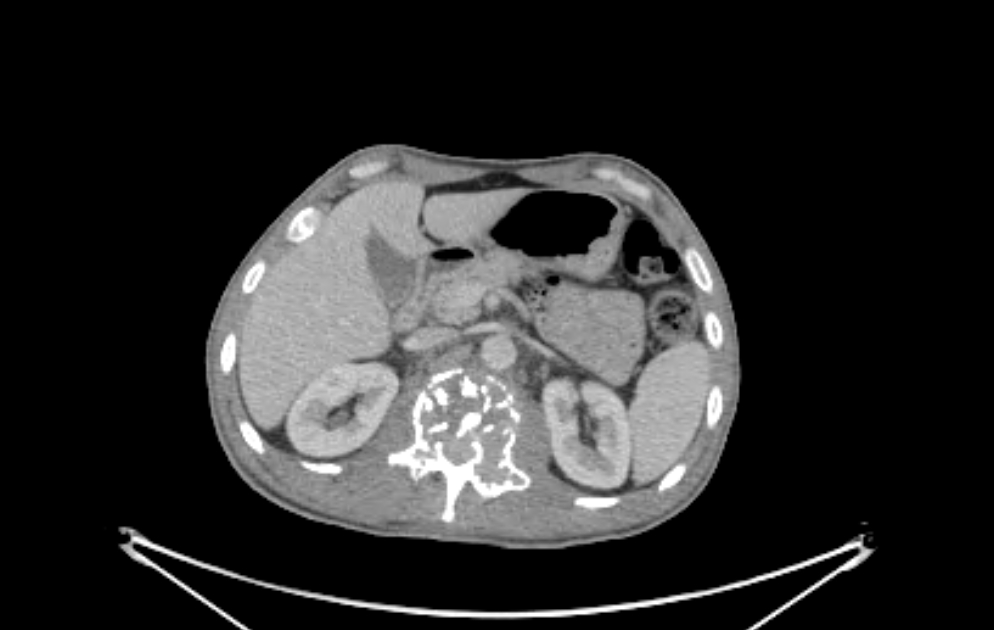 Solitary bone plasmacytoma (PET-CT) | Image | Radiopaedia.org