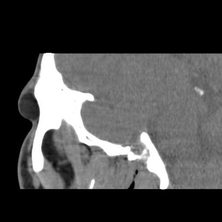 Upper eyelid dermoid cyst | Image | Radiopaedia.org