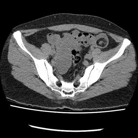 icd 10 code for bilateral ovarian dermoid cyst