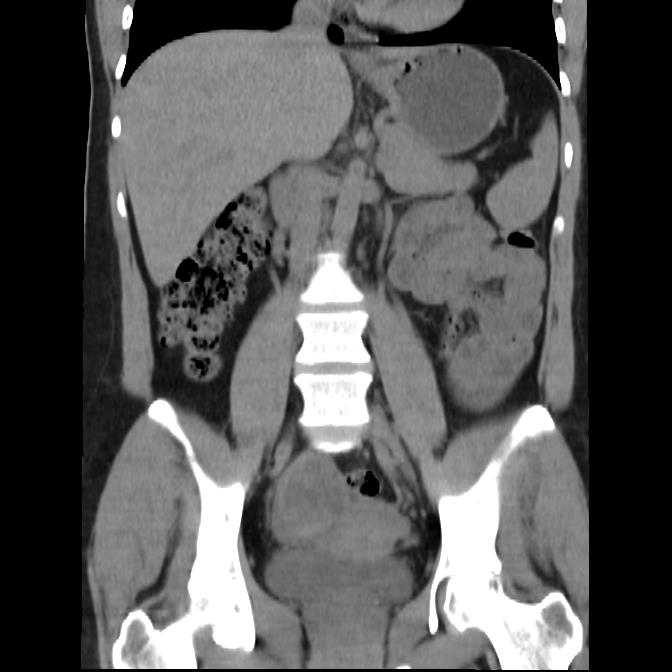 Bilateral Ovarian Dermoid Cyst Image