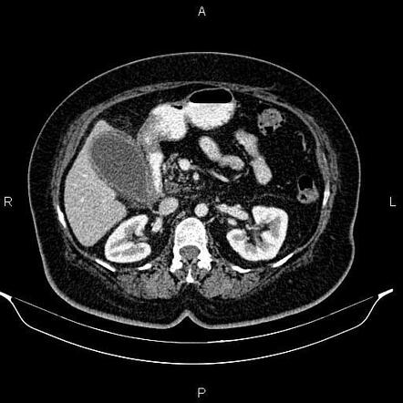 Acute Cholecystitis | Radiology Reference Article | Radiopaedia.org