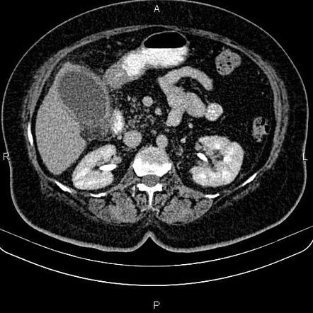 Acute cholecystitis | Image | Radiopaedia.org