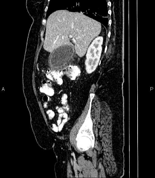 Acute Cholecystitis | Image | Radiopaedia.org