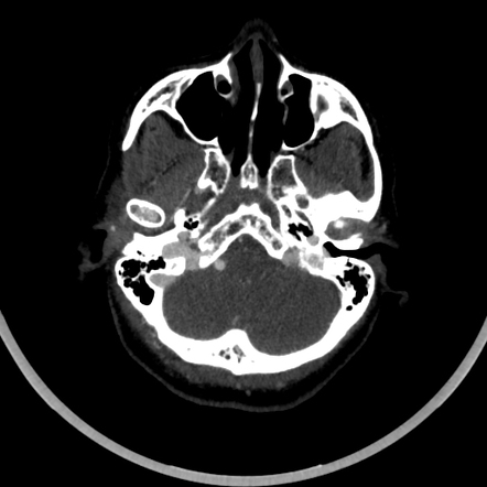 Glomus jugulotympanicum paraganglioma | Radiology Reference Article ...