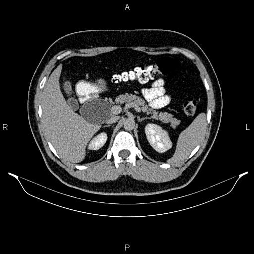 Choledochal cyst - type I | Image | Radiopaedia.org