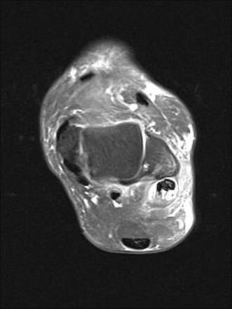 Concomitant peroneal tendons intrasubstance tear | Radiology Case ...