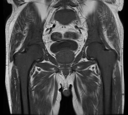 Myelofibrosis | Radiology Case | Radiopaedia.org