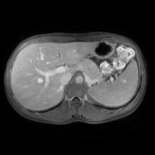 Focal nodular hyperplasia (FNH) | Image | Radiopaedia.org