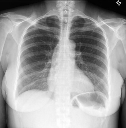 Pericardial effusion | Image | Radiopaedia.org