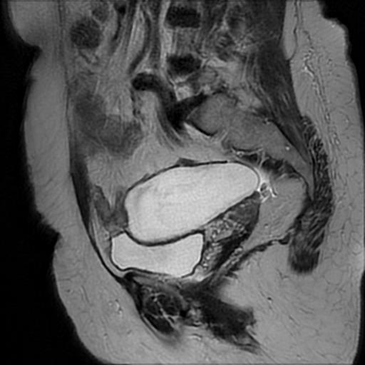 Appendiceal Mucocele Image