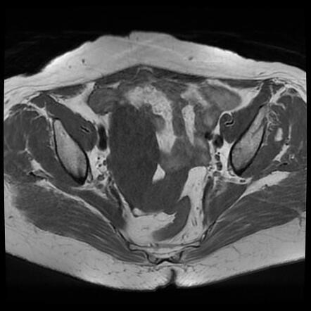 Appendiceal Mucocele | Image | Radiopaedia.org