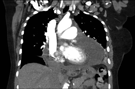 Pericardial effusion | Image | Radiopaedia.org