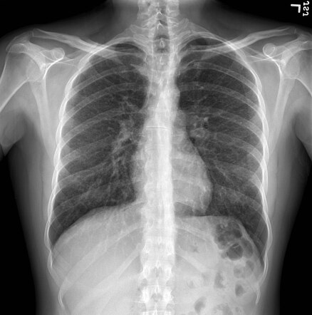 Miliary sarcoidosis | Image | Radiopaedia.org